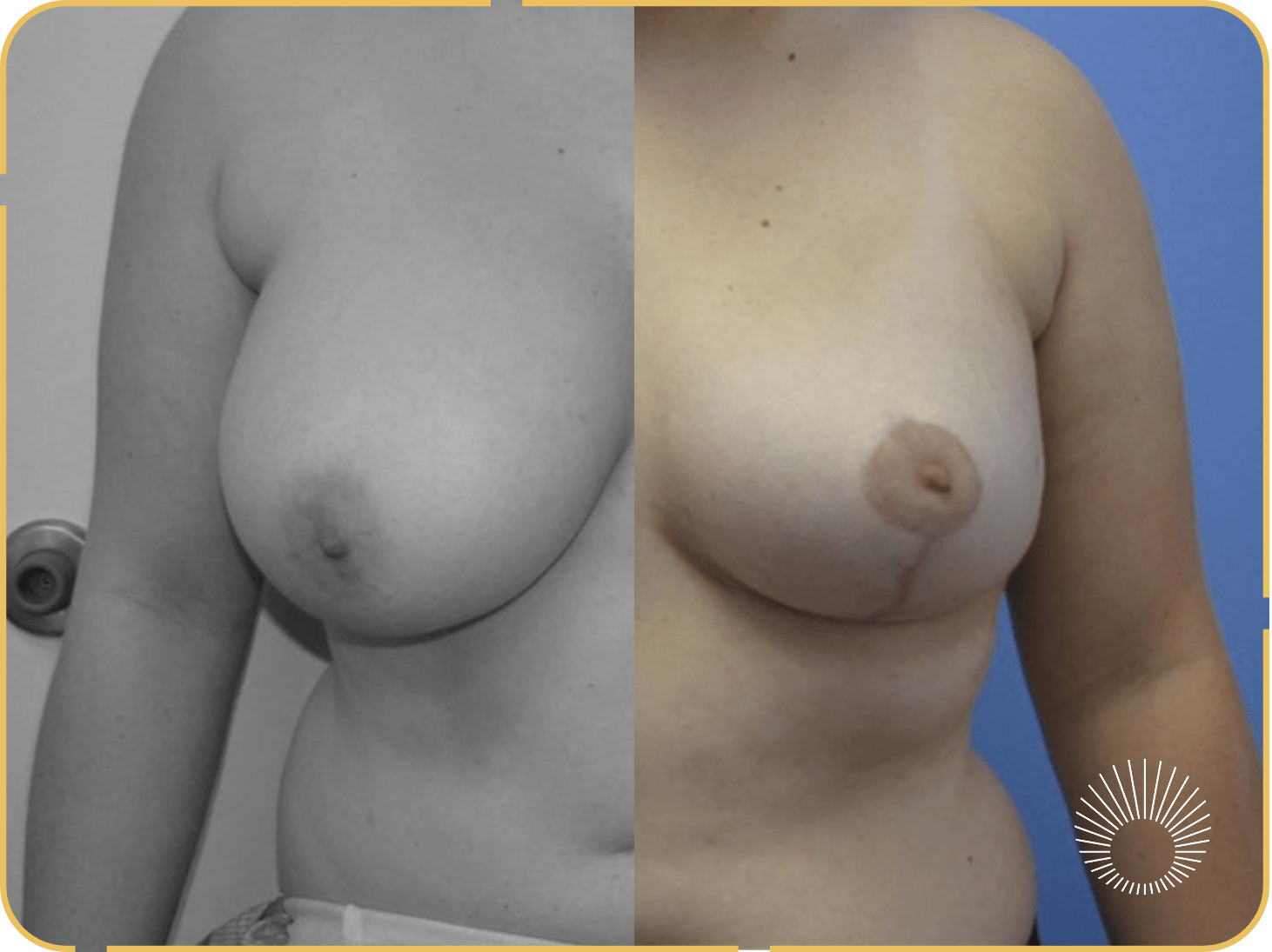 Breast Reduction 1