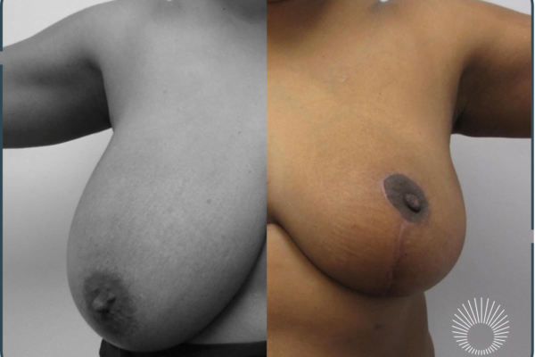 Breast Reduction +