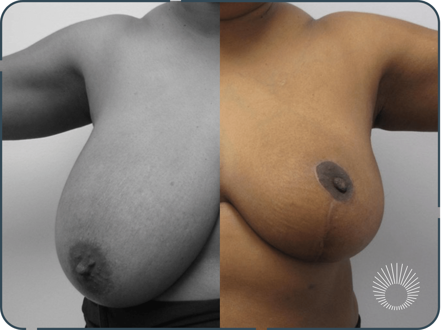 Breast Reduction 2