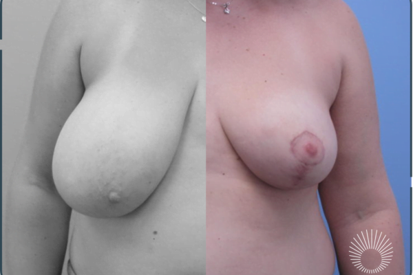 Breast Reduction +