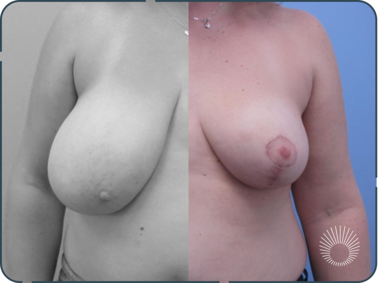 Breast Reduction 3