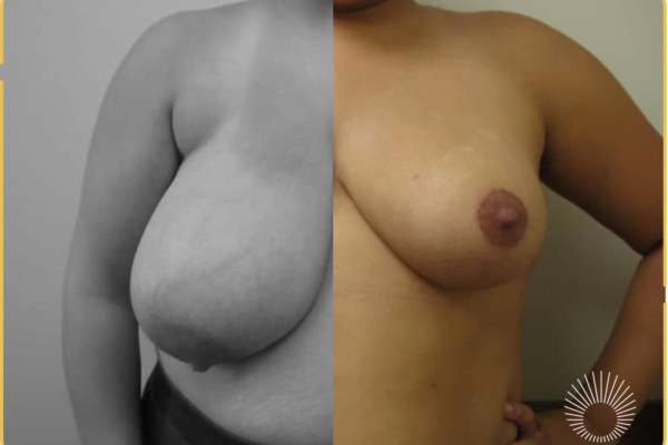 Breast Reduction +