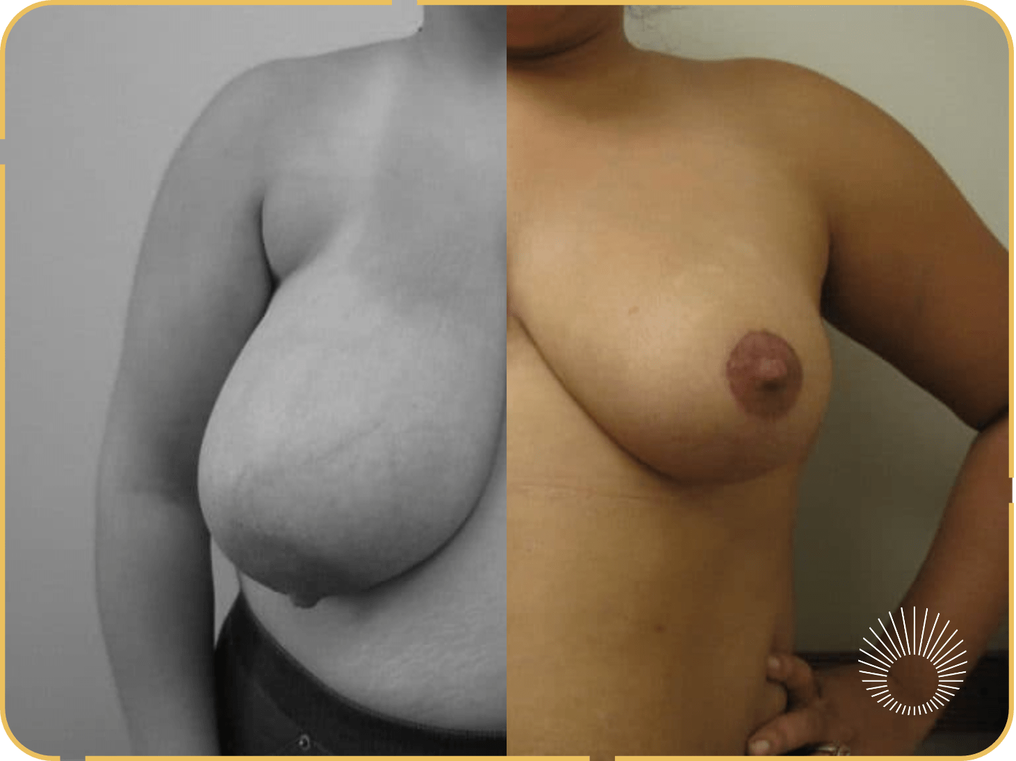 Breast Reduction 4