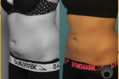 Body Shaping: Abdominal Liposuction