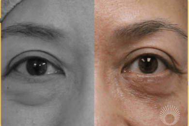 ~Undereye Bags: Eye Surgery