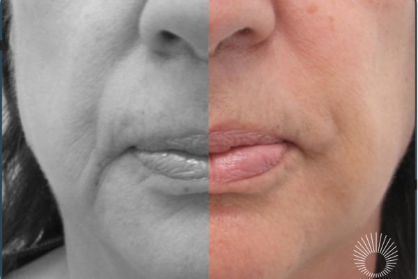 ~Marionette Lines: Hyaluronic Acid Filler