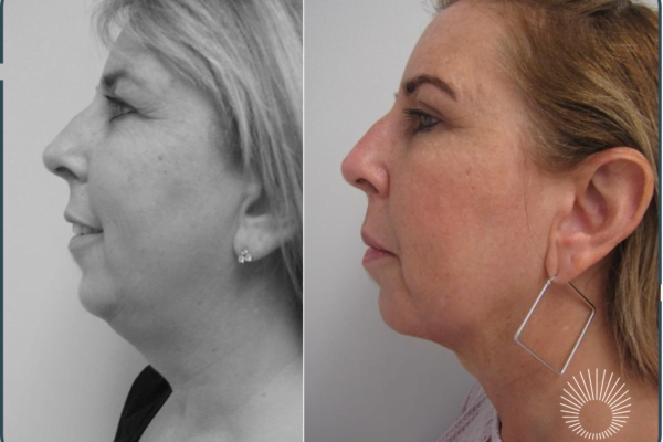 Neck Shaping: Submental Liposuction
