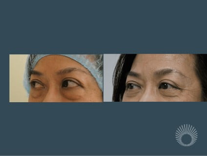 Lower eyelid surgery before and after photos
