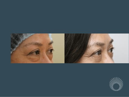 Lower eyelid surgery before and after photos