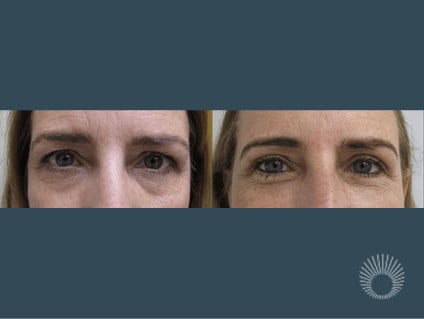 Upper Eyelid before and after photos