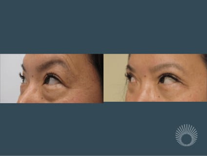 Upper and lower eyelids before and after photos