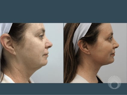 lower face and neck lift before and after photos