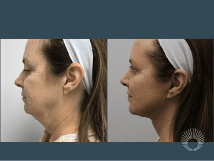 lower face and neck lift before and after photos