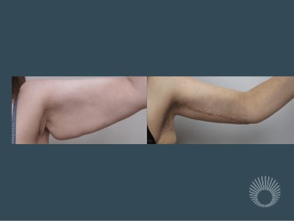 Arm Lift surgery before and after photos