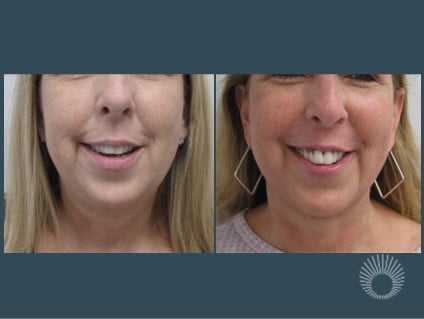 Neck liposuction before and after photos