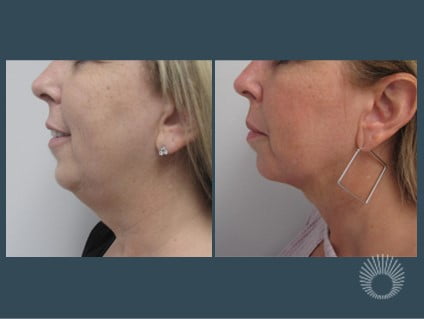 Neck liposuction before and after photos