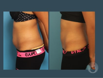 Liposuction surgery before and after photos