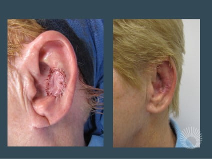 Left Ear Pedicle Flap 2