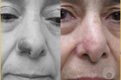 Skin Lesions: Birthmark Removal