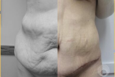 Body Shaping: Circumferential Tummy Tuck