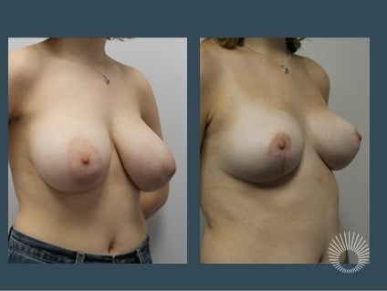 breast redux 6d