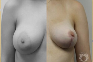 Breast Reduction +