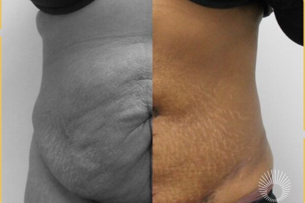 Body Shaping: Tummy Tuck