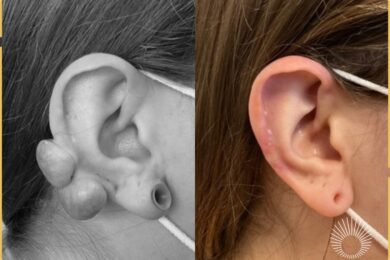 Skin Lesions: Keloid Removal