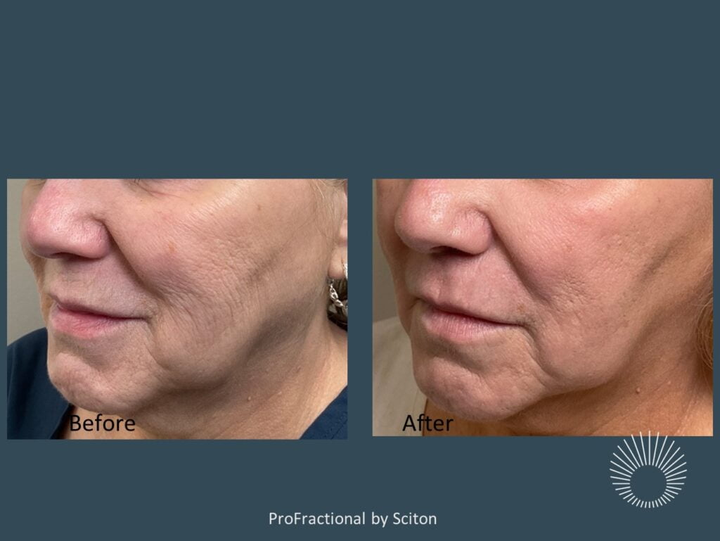 ProFractional by Sciton Dr. Sara Dickie Plastic & Reconstructive Surgery