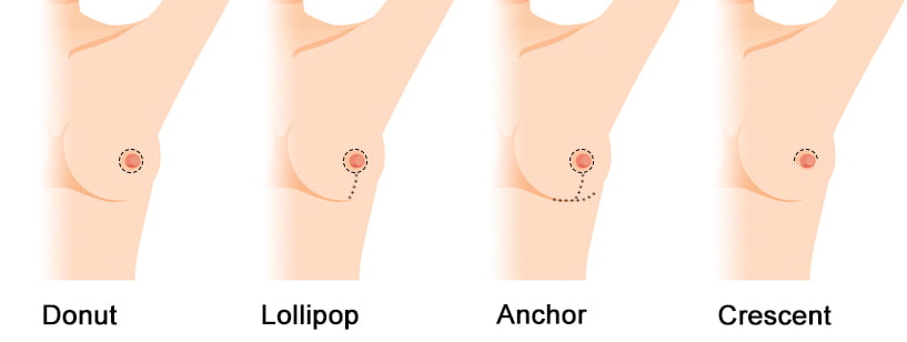 breast incisions