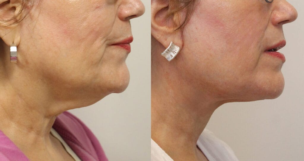 Neck lift Morton Grove Chicago Area Before and After