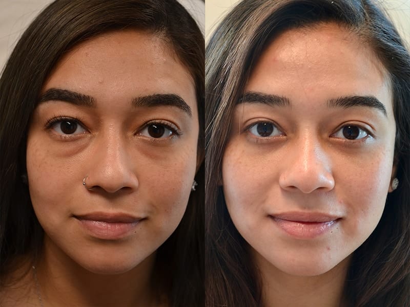 Lower eyelid surgery