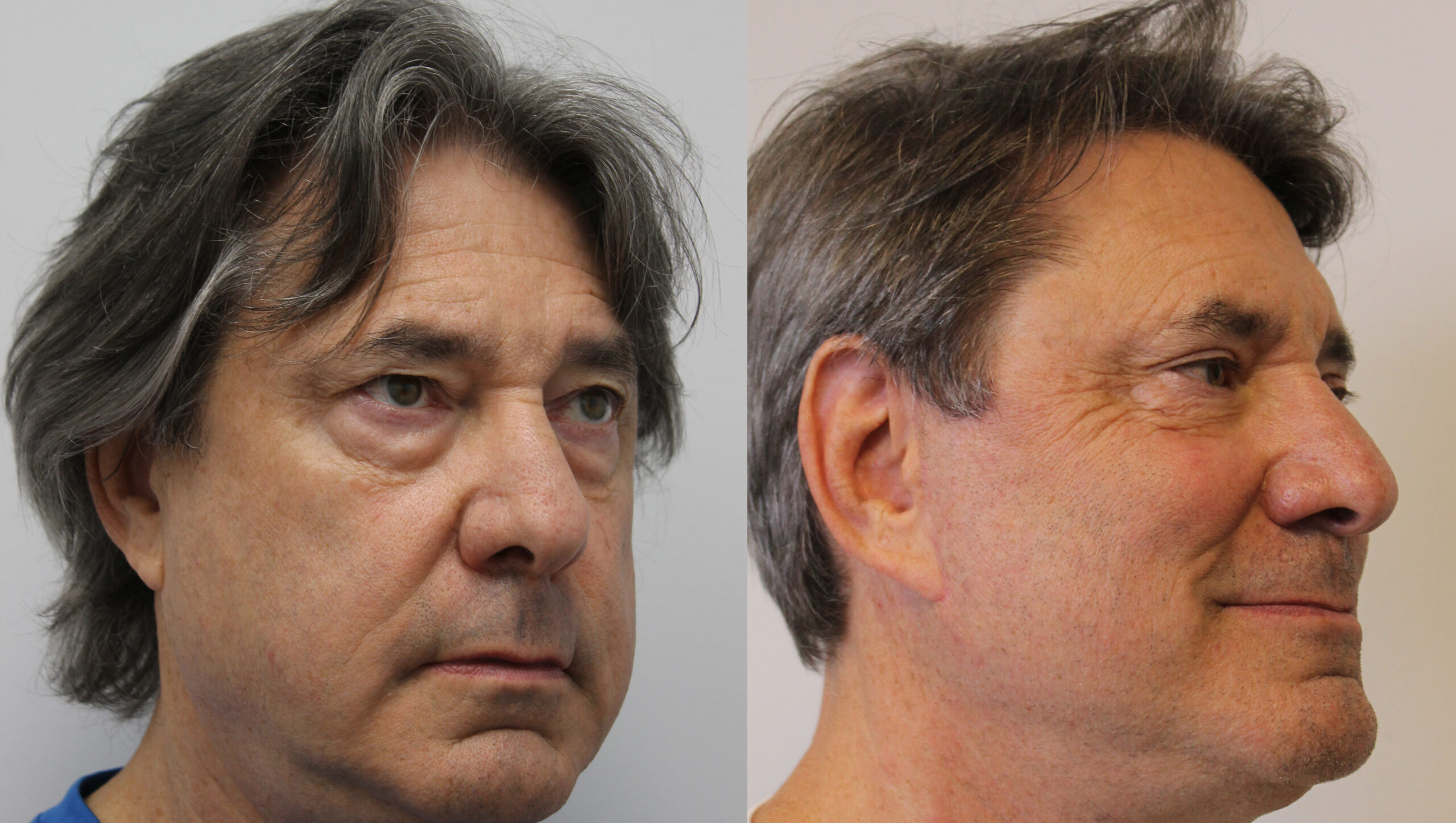 Male Blepharoplasty 02 Male Blepharoplasty 02
