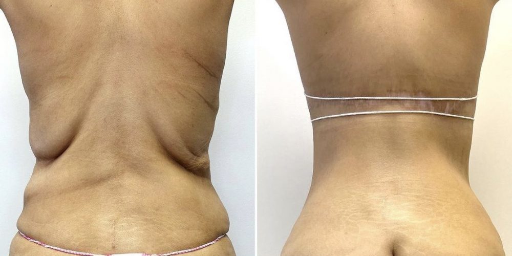 Back and Lower Body Contouring Options