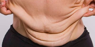 Body Contouring