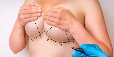 Implant or a Lift breast plastic surgey