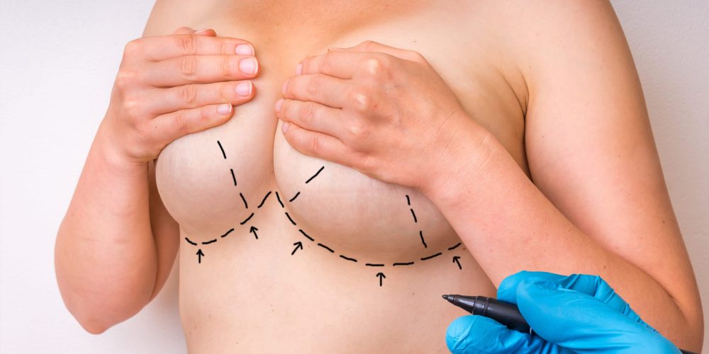 Implant or a Lift breast plastic surgey