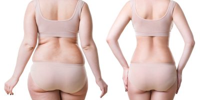 Woman's,Body,Before,And,After,Weight,Loss,Isolated,On,White