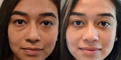 Lower eyelid surgery