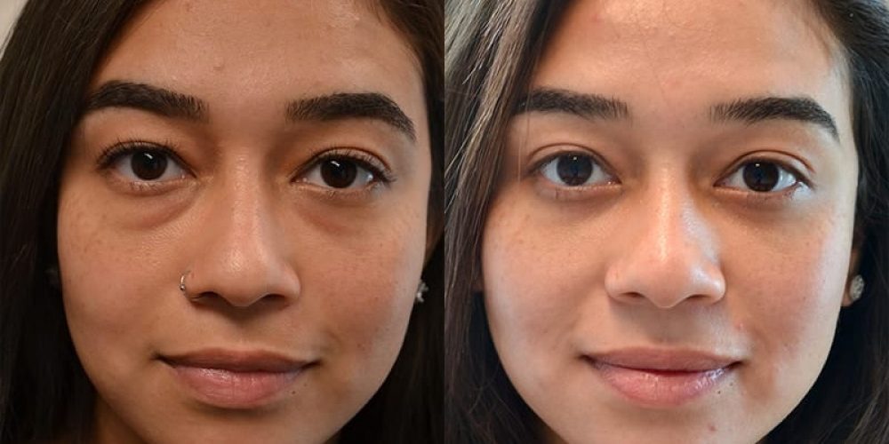 Lower eyelid surgery