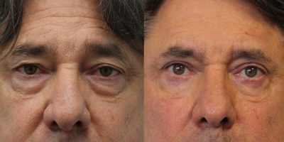 Male Blepharoplasty 01 Male Blepharoplasty 01