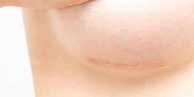 Scarring in Plastic Surgery