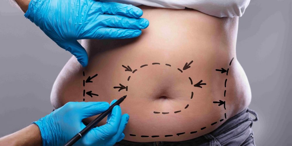 Tummy Tuck Surgery Chicago