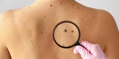 what to do if you have skin cancer